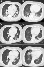 Chest computed tomography images from a patient with severe murine typhus detected by nanopore targeted sequencing, China. A, B) Images taken at hospital admission demonstrating pneumonic exudation of the left lung lingual segment and double lower lobes and small plural effusion. C, D) Improvement of pulmonary infiltrates after 14 days. E, F) Resolution of pulmonary infiltrates demonstrated 1 month after hospital discharge.