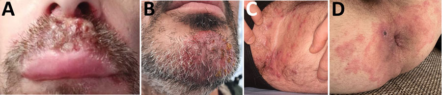 Clinical appearance of Trichohpyton mentagrophytes genotype VII infections in men in France, 2022. A, B) Swollen lesions of the mustache (A) and beard (kerions) (B). C) Papular and nodular inguinal lesions. D) Peri-anal mpox lesions with associated papules and pustules with central umbilication and a large lesion with a central necrotic crust, surrounded by extensive erythemato-squamous circinate lesions caused by TMVII infection.