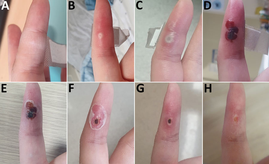 Progression of skin lesion caused by occupational transmission of monkeypox virus to a healthcare worker in South Korea. The healthcare worker was infected in the left index finger with monkeypox virus after a needlestick from a 26G needle during aspiration of an infected patient’s vesicle. Photographs show the lesion at the inoculation site from onset to recovery. A) Day 1 (November 17, 2022); B) day 6; C) day 8; d) day 18; E) day 22; F) day 25; G) day 34; H) day 40.
