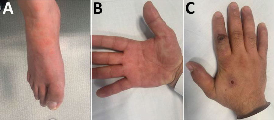 Orf virus infection in a 26-year-old man after contact with slaughtered sheep and goats, France, 2022. A, B) Target lesion characteristic of erythema multiforme predominant on the foot (A) and hand (B). C) Nodule caused with a necrotic pustule center surrounded by a grayish-white edematous crown on the left index finger. Lesion was swabbed and tested by using a parapoxvirus PCR test.