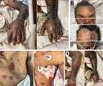 Changes in skin lesions despite aggressive treatment with antiviral medications in patient with severe mpox and untreated HIV, Baltimore, Maryland, USA: A) left hand, B) face, C) trunk, and D) left arm and elbow. Images at left taken on day 65, after 18 days of tecovirimat and 1 dose of brincidofovir. Images at right taken on day 73, after 26 days of tecovirimat, 2 doses of brincidofovir, and 1 dose of vaccinia immune globulin intravenous.