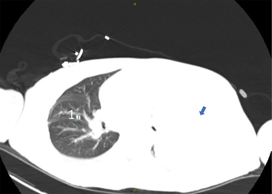 Computed tomography scan of lung showing right-sided pulmonary nodule (marked as 1) and large left pleural effusion (blue arrow) in patient with severe mpox and untreated HIV, Baltimore, Maryland, USA.