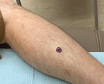 Limited cutaneous leishmaniasis as ulcerated verrucous plaque on leg of patient in Tucson, Arizona, USA. A solitary, nonhealing plaque with central ulceration is shown on the right proximal lateral pretibial region.