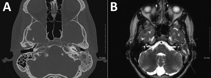 Radiographic findings from 22-year-old Hispanic man from California, USA (case 4), in multicentric case series of coccidioidal otomastoiditis. A) Computed tomography scan of the head, showing opacification of the mastoid. B) Magnetic resonance image of brain, showing mastoiditis.