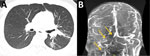 Radiographic findings from 25-year-old Hispanic man from New Mexico, USA (case 5), in multicentric case series of coccidioidal otomastoiditis. A) Computed tomography scan of the chest with contrast, showing septic emboli of the left lower lung lobe and lingula with developing pneumonia. B) Magnetic resonance venogram, showing stable thrombus of the right jugular bulb, right sigmoid and transverse sinuses, and partially occlusive thrombus in the anterior superior sagittal sinus, seen by lack of enhancement (arrows) compared with the left side.