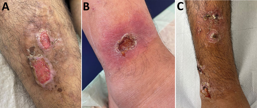 Clinical manifestations of Corynebacterium diphtheriae skin infections in patients at a refugee reception center in Freiburg. Germany, 2022. A) Chronic erosive skin lesions at the ventral lower thigh. Toxigenic C. diphtheriae, methicillin-sensitive Staphylococcus aureus (MSSA), and Streptococcus pyogenes were grown from skin swab samples. B) Ulcerative lesion with erythematous halo just above the right ankle. C. diphtheriae, MSSA, and S. pyogenes were detected from skin swab samples. C) Ecthymata at the lower leg without detection of C. diphtheriae but with growth of MSSA and S. pyogenes.