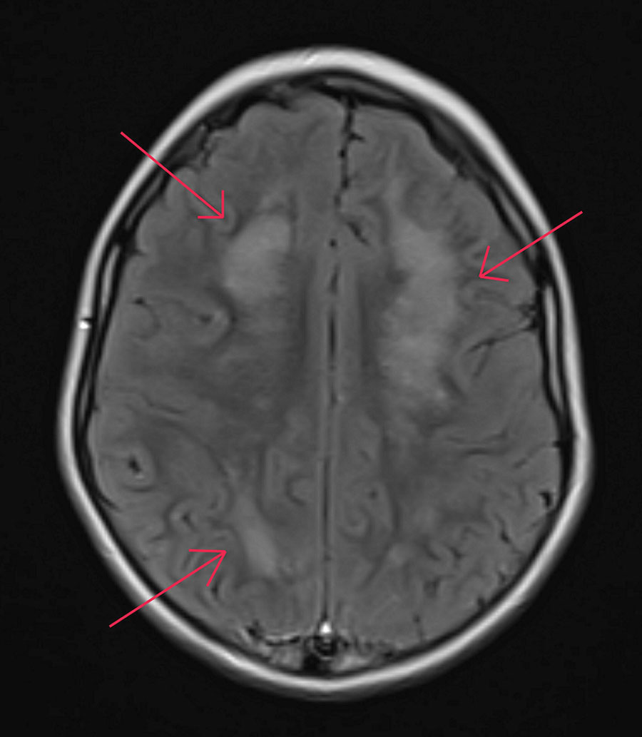 Magnetic resonance imaging of brain of child with autism spectrum disorder infected with Baylisascaris procyonis roundworms, Washington, USA, 2022. Axial section of the brain shows patchy white matter disease with limited gray matter involvement. Red arrows indicate diseased regions.