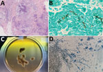 Histological analyses of cutaneous pythiosis in 2 dogs, Italy. A) Section from punch biopsy of cutaneous mass showing confluent pyogranulomatous and eosinophilic granulomas with central necrosis in the deep dermis and panniculus. Hematoxylin and eosin stain; original magnification ×100. B) Section from punch biopsy of cutaneous mass showing broad, irregular branching hyphae. Grocott methenamine silver stain; original magnification ×400. C) Culture (24-hour) of an aspirate from a mass found in case 2. Aspirate was cultured on Sabouraud dextrose agar without antimicrobial drugs, and showed submerged, colorless colonies with irregular radiate patterns. D) Microscopic appearance of the colonies indicating broad (4–10 µm in diameter), hyaline, and sparsely septate hyphae. Original magnification ×250.