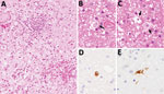 Brain biopsy from patient (patient 2) with Macacine alphaherpesvirus 1 (herpes B virus) infection, Japan, 2019. A–C) Inflammatory cell infiltration and hemorrhage observed around blood vessels in the cerebellar white matter. Arrows indicate nuclear inclusion bodies (B, C). Hematoxylin and eosin stain. D, E) Immunohistochemical analysis using B virus gB mouse monoclonal (clone 19B6) (D) and an B virus rabbit polyclonal (E) antibodies as the primary antibodies. Original magnification × 200 for all images.