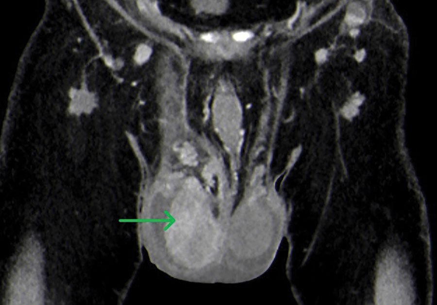 Computed tomography of patient who had human tularemia epididymo-orchitis caused by Francisella tularensis subspecies holartica, Austria. Coronal image shows the right testicle (arrow) during the arterial phase with hyperperfusion and nonperfused areas (abscess).