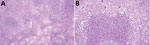 Granulomatous epididymo-orchitis in patient who had human tularemia epididymo-orchitis caused by Francisella tularensis subspecies holartica, Austria. A) Diffuse chronic granulomatous inflammation in the interstitium and between the seminiferous tubule. Hematoxylin and eosin stain; original magnification ×20. B) Suppurative granuloma with epithelioid cells and single giant cells in testicular tissue. Hematoxylin and eosin stain; original magnification ×100.