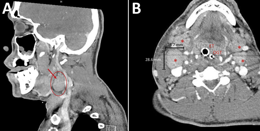 Computed tomography scans of patient’s neck in study of pharyngeal co-infections with monkeypox virus and group A Streptococcus, United States, 2022. A) Sagittal view of neck of patient A (39-year-old man) showing massive cervical lymphadenopathy (red circle and arrow). B) Axial view of hypopharynx of patient A after intubation with endotracheal tube. Asterisks show enlarged cervical lymph nodes. Patient was dependent on endotracheal tube because of soft tissue edema along the airway. ET, endotracheal tube; OGT, orogastric tube.