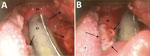 Video laryngoscopy images of patient larynx and pharynx in study of pharyngeal co-infections with monkeypox virus and group A Streptococcus, United States, 2022. A) View of oropharynx, hypopharynx, and laryngeal inlet of patient A (39-year-old man). Arrows indicate mpox lesions. B) Detailed view of mpox lesions. Arrows indicate several lesions. EP, epiglottis; ET, endotracheal tube; OP, oropharynx (lateral wall); T, tongue.