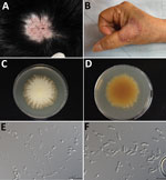 Clinical manifestations in 2 patients with rare cases of skin dermatophytosis caused by Nannizzia polymorpha. A) Case-patient 1, with tinea capitis; B) case-patient 2, with tinea manuum. C, D) The colony of isolate CGMHD 3492 isolated from case-patient 1 on potato dextrose agar obverse (C) and reverse (D). E, F) Microscopic features of microconidia (E) and macroconidia (F) (scale bars = 50 μm).