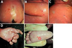 Cutaneous lesions on a stillborn fetus with congenital mpox after placental monkeypox infection and intrauterine transmission, Democratic Republic of the Congo, 2008. A) Buttocks; B) right upper arm; C) right shoulder and back; D) palm of left hand (arrow); E) plantar surface of left foot (arrow).