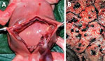 Evidence of congenital mpox syndrome from a stillborn fetus after placental monkeypox infection and intrauterine transmission, Democratic Republic of the Congo, 2008. A) Marked hepatomegaly demonstrating liver twice normal size for gestational age, ascites, and hydrops. B) The maternal surface of the placenta had numerous discrete punctate hemorrhages. 