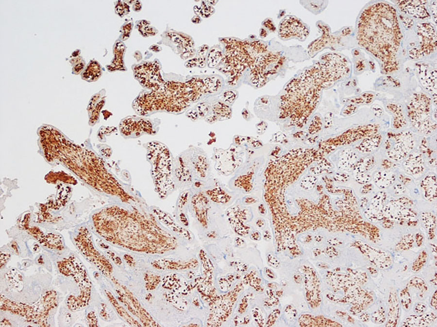 Immunohistochemistry of placenta from a stillborn fetus after placental monkeypox infection and intrauterine transmission, Democratic Republic of the Congo, 2008. Microscopic findings show diffuse and intense positive staining for orthopoxvirus antigen in Hofbauer cells in the chorionic villi. Immunohistochemistry with antibody to vaccinIa virus counterstained with hematoxylin and eosin. Original magnification ×10.