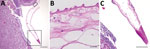 Histologic sections of resected Taenia martis metacestode from a patient in Switzerland. A) Cross-section through the excised tissue revealed strong infiltration surrounding a structure suggestive of parasitic origin. Boxed areas are shown in a higher magnification in panels B and C. B, C) The metacestode’s cyst wall, showing the warty appearance (B) characteristic of tapeworm metacestodes’ tegument (3,4). Hematoxylin and eosin stain. Scale bars indicate 200 μM (A), 10 μM (B), and 100 μM (C).