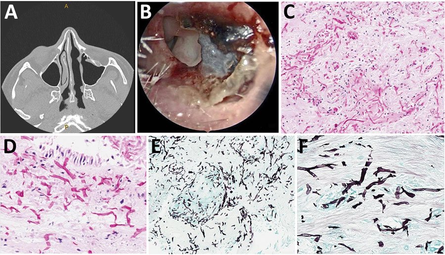 Computed tomography, endoscopic findings, and histomorphology of rhinosinusitis caused by Choanephora infundibulifera in a man with leukemia in Memphis, Tennessee, USA. A) Computed tomography shows new asymmetric swelling of the anterior nasal septum and irregularity of the right septum, edema of the inferior turbinates, and obstruction of the right frontal sinus outflow tract. A septal perforation, the sequela of the patient’s previous fungal rhinosinusitis, was stable. B) Nasal endoscopy reveals necrosis of the anterior nasal septa. C, D) Necrotic sinonasal mucosa contains numerous hyaline (nonpigmented) fungal elements with broad (ribbon-like), thin-walled, nonseptated, and pleomorphic fungal hyphae. Hematoxylin and eosin stain; original magnification ×200 for panel C, ×400 for panel D. E, F) Gomori methenamine-silver stain highlights the fungal elements (in black). Original magnification ×200 for panel E, ×400 for panel F.