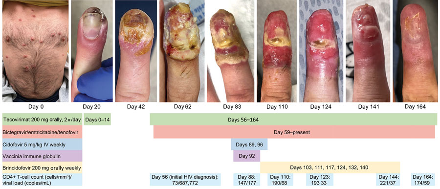 Initial lesions on trunk (day 0, when the patient first sought care at an urgent care clinic) and visual timeline of right index finger lesion of immunocompromised patient with mpox, California, USA, 2022. Treatment received, CD4+ T-cell count, and viral load are indicated below images. IV, intravenous.