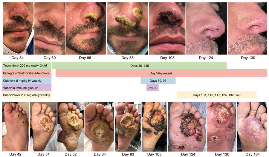 Visual timeline of facial lesions (top) and left plantar lesions (bottom) of immunocompromised patient with mpox, California, USA, 2022. Treatment received is indicated between images. IV, intravenous.