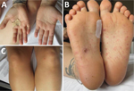 Rat bite fever lesions on 32-year-old female patient, Germany, 2022. At the time of patient’s readmission, reddish papules appeared on the palms of the hands (A), soles of the feet (B), and legs (C). 