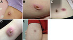 Clinical images of cutaneous melioidosis among children after sporting event, Australia. A) Cutaneous pustular lesion on the left arm of case 1; lesion initially appeared at 19 days postexposure (dpi). B) Cutaneous ulcerative lesion on the right leg of case-patient 2; lesion initially appeared at 14 dpi. C) Cutaneous lesion near the umbilicus of case-patient 3; lesion initially appeared at 18 dpi. D) Cutaneous lesion on the left arm of case-patient 4; lesion initially appeared at 31 dpi. E) Cutaneous lesion on the right arm of case-patient 5; lesion initially appeared at 12 dpi.