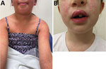 Clinical images of adverse reactions secondary to trimethoprim/sulfamethoxazole among children treated for cutaneous melioidosis after a sporting event, Australia. A) Widespread, erythematous, pruritic rash in case-patient 1 that began 9 days after commencing trimethoprim-sulfamethoxazole. B) Lip swelling and a widespread erythematous rash in case-patient 2 that began 16 days after commencing trimethoprim/sulfamethoxazole.