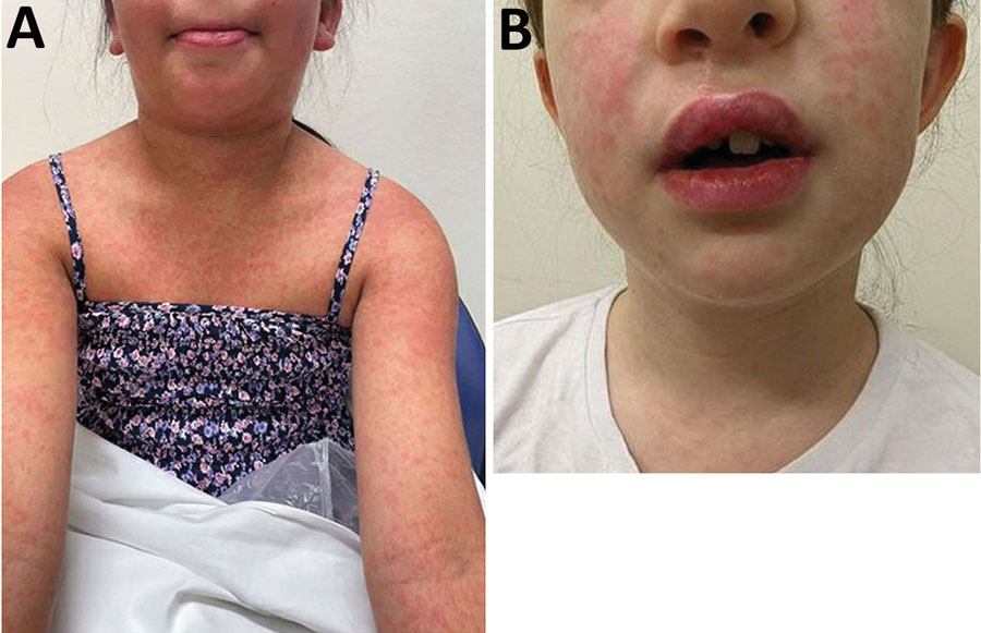 Clinical images of adverse reactions secondary to trimethoprim/sulfamethoxazole among children treated for cutaneous melioidosis after a sporting event, Australia. A) Widespread, erythematous, pruritic rash in case-patient 1 that began 9 days after commencing trimethoprim-sulfamethoxazole. B) Lip swelling and a widespread erythematous rash in case-patient 2 that began 16 days after commencing trimethoprim/sulfamethoxazole.