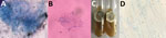 Testing for Scedosporium aurianticum infection 2 recipients of kidney transplants from deceased near-drowning donor, India. A, B) Potassium hydroxide mount of renal allograft tissue from transplant recipient 1 (A) and skin biopsy from transplant recipient 2 (B) showing septate hyphae. C) Culture on Sabouraud dextrose agar showing a greyish-white colony of S. aurianticum. D) Lactophenol cotton blue mount from a culture showing smooth-walled sessile conidia on cylindrical or flask-shaped conidiogenous cells.  