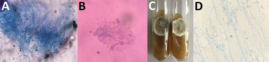 Testing for Scedosporium aurianticum infection in 2 recipients of kidney transplants from deceased near-drowning donor, India. A, B) Potassium hydroxide mount of renal allograft tissue from transplant recipient 1 (A) and skin biopsy from transplant recipient 2 (B) showing septate hyphae. C) Culture on Sabouraud dextrose agar showing a greyish-white colony of S. aurianticum from recipients 1 (left) and 2 (right). D) Lactophenol cotton blue mount from a culture from recipient 1 showing smooth-walled sessile conidia on cylindrical or flask-shaped conidiogenous cells.  