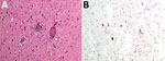 Histopathologic findings from the brain of a wild chamois with tick-borne encephalitis virus found in the Lombardy region of Italy in May 2023. A) Severe, chronic, nonpurulent meningoencephalitis characterized by perivascular lymphohistiocytic cuffs. Hematoxylin-eosin stain; original magnification ×20. B) Neuronal positivity for tick-borne encephalitis virus. Immunohistochemistry; original magnification ×20.