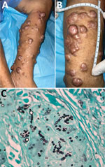 Lesions from an 87-year-old woman from Capira in western Panama, determined to be lobomycosis caused by infection with the fungus Paracoccidioides (Lacazia) loboi. A, B) Multiple keloid-like nodules on the left leg extending through the mid-distal third of the posterior aspect of the left thigh of the patient who had lobomycosis. Shown are the classic confluent arrangement and hyperpigmented aspect of lesions. C) Tissue stain showing classic oval-to-round-shaped cells with connecting tubular projections arranging in a string-of-pearls pattern, both in pairs and individually. Gömöri methenamine silver stain; original magnification ×100.