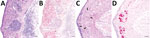 Representative tissue sections from the central nervous system of an alligator snapping turtle (Macrochelys sp.) with meningoencephalomyelitis, United States, 2009. A) Cerebellum; lymphoplasmacytic perivascular cuffs (asterisk) and infiltrates are widely disseminated in the gray matter and the adjacent leptomeninges. Hematoxylin and eosin stain. B) Replicate section of the same tissue shown in panel A. There is strong in situ hybridization signal (red) against freshwater turtle neural virus 1 (FTuNV1) in the cytoplasm of small neurons and glial cells throughout the gray matter and associated with the lymphoplasmacytic infiltrates. Hematoxylin counterstain. C) Optic tectum; several neurons have central chromatolysis (arrows). Hematoxylin and eosin stain. D) A replicate section of the tissue shown in panel C. Intense in situ hybridization signal (red) against FTuNV1 was within the neuronal and glial cytoplasm. Scale bars indicate 50 µm. 