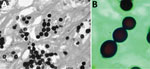 A) Grocott methamine silver–stained section from a skin biopsy specimen of a bottlenose dolphin (Tursiops truncatus) showing abundant Lacazia loboi yeast cells individually and in chains connected by thin tubular bridges. Source: Emerging Infectious Diseases 15 (4) April 2009. B) L. loboi yeast cells in chains connected by thin tubular bridges. Source: Centers for Disease Control and Prevention.