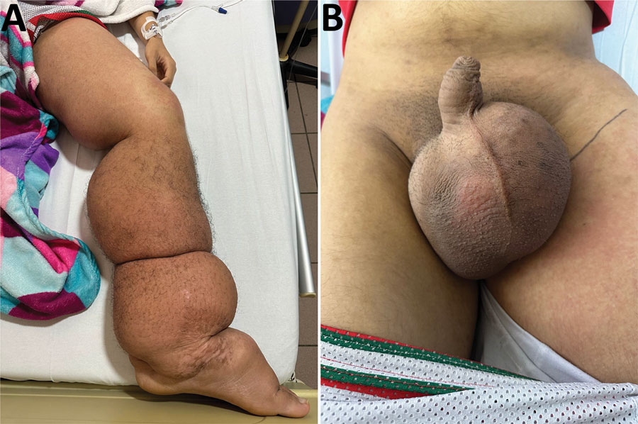 Images of a 14-year-old patient from Colombia experiencing severe progressive lymphedema caused by a Wuchereria bancrofti nematode infection. A) Patient’s left lower limb, showing generalized lymphedema extending from the foot to the genital region along with erythematous areas involving the left thigh and areas of perimaleolar hypocromia and hypercromia reflective of post-inflammatory trophic skin changes. B) Severe scrotal edema (hydrocele).
