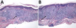 Histologic analysis of skin biopsies from a 55-year-old female patient with leprosy in north Florida, USA. Skin biopsies from right proximal ventral forearm (A) and left distal dorsal forearm (B) underwent hematoxylin and eosin staining. Arrows indicate areas of dermal granulomatous inflammation. Original magnification ×100. 