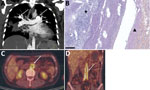Imaging of pulmonary arteritis and abdominal aortitis for case-patients 2 and 3 in study of unexpected vascular locations of Scedosporium spp. and Lomentospora prolificans fungal infections, France. A) Thoracic computed tomography scan for case-patient 2. Arrows indicate left pulmonary artery and right lobar pulmonary artery mycotic aneurysms. B) Hematoxylin-eosin-saffron stain of lung tissue from postmortem analysis of case-patient 2. Triangle indicates bronchial artery wall; star indicates bronchial artery thrombus consisting of radially-disposed multiple septate hyphae. Scale bar indicates 250 μm. C, D) Positron emission tomography-computed tomography scans of case-patient 3. C) Arrow indicates intense abdominal aorta hypermetabolism. D) Arrow indicates abdominal aorta and primitive iliac artery hypermetabolisms. Data are from the Scedosporiosis/lomentosporiosis Observational Study (12).