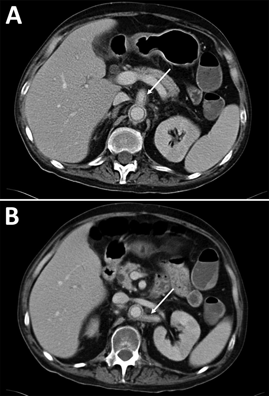 Abdominal computed tomography scans for case-patient 5 showing aortitis in study of unexpected vascular locations of Scedosporium spp. and Lomentospora prolificans fungal infections, France. A) Arrow indicates abdominal aorta and superior mesenteric artery thickening and perivascular contrast. B) Arrow indicates abdominal aorta and left renal artery thickening and perivascular contrast. Data are from the Scedosporiosis/lomentosporiosis Observational Study (12).