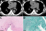Radiologic and histopathologic analysis of thoracic aortitis in case-patient 6 in study of unexpected vascular locations of Scedosporium spp. and Lomentospora prolificans fungal infections, France. A) Thoracic computed tomography scan showing sacciform aneurysm of ascending aorta (star). B) Thoracic computed tomography scan 21 days later showing the rapidly growing aneurysm (star). C) Hematoxylin-eosin-saffron stain of thoracic aorta section. Star indicates thoracic aorta wall dissection. Triangle indicates tunica media. Scale bar indicates 1 mm. D) Grocott-Gomori methenamine silver stain of thoracic aorta section. Star indicates septate fungal hyphae invading the thoracic aorta tunica media. Triangle indicates thrombus containing septate fungal hyphae. Scale bar indicates 100 μm. Data are from the Scedosporiosis/lomentosporiosis Observational Study (12).