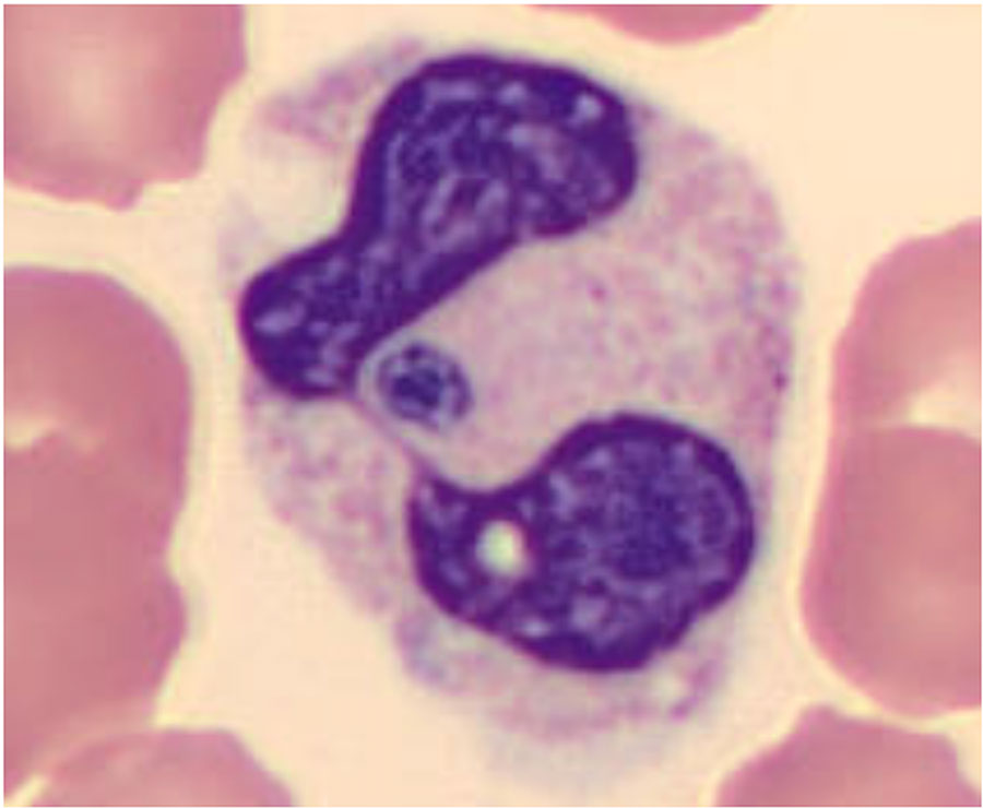 Peripheral blood smear from a sample studied as part of an investigation into increased recognition of human anaplasmosis, Ontario, Canada, 2021. Morulae (deep purple inclusions) can be visualized within the neutrophil. Wright’s stain, original magnification ×100.