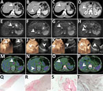 Diagnostic tests for patient in Italy with confirmed autochthonous case of human alveolar echinococcosis, 2023; white arrows indicate lesions. A–D) Contrast-enhanced computed tomography arterial phase. E–H) T2-weighted magnetic resonance imaging. I–L) Ultrasonography and contrast-enhanced ultrasonography. M–P) 18F-FDG-PET scan delayed acquisition (4 hours). Q–T) Em2 immunohistochemistry indicating small particles of Echinococcus multilocularis (spems) stained in red in patient’s sample (original magnification ×2.5 [Q] and ×20 [R]); positive alveolar echinococcosis sample control (original magnification ×20 [S]); Em2 negative control (cystic echinococcosis case, negative laminated layer; original magnification ×20) (T).