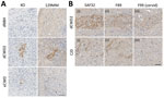 Prion protein (PrP) deposits in organoids. A) Deposits of PrP in 129MM and KO organoids detected with SAF32 antibody in study of lack of transmission of chronic wasting disease prions to human cerebral organoids. B) Prion deposition in sequential slices of representative 129MV organoids is detected by both SAF32 (i) and F89 (ii) total PrP antibodies in both CWD and CJD inoculated organoids. Cervid PrP-specific antibody F99 (iii) detects the same deposits in the just the CWD inoculated organoids, indicating that the deposits are of cervid origin (i.e., inocula) and not misfolded human PrP. Scale bars indicate 50 µm. CJD, Creutzfeldt-Jakob disease; CWD, chronic wasting disease; dCWD2, mule deer CWD; dNBH, deer normal brain homogenate; eCWD, elk CWD; KO, knockout.