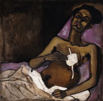 Alice Neels’ 1940 painting “TB Harlem” depicting tuberculosis in New York City, portraying Carlos Negrón after thoracoplasty. Image from the National Museum of Women in the Arts, Gift of Wallace and Wilhelmina Holladay. Copyright © The Estate of Alice Neel/Courtesy of David Zwirner, New York. Previously published by Emerging Infectious Diseases (https://wwwnc.cdc.gov/eid/article/19/3/ac-1903_article).