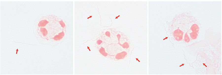 Spirochetes (red arrows) visualized on Gram stain in a cerebrospinal fluid sample from a 68-year-old man with immunosuppression from rituximab, Minnesota, USA. Visualization was done after concentration using cytospin (original magnification ×1,000 with oil immersion). The spirochetes were later identified as Borrelia miyamotoi by 16S ribosomal sequencing.