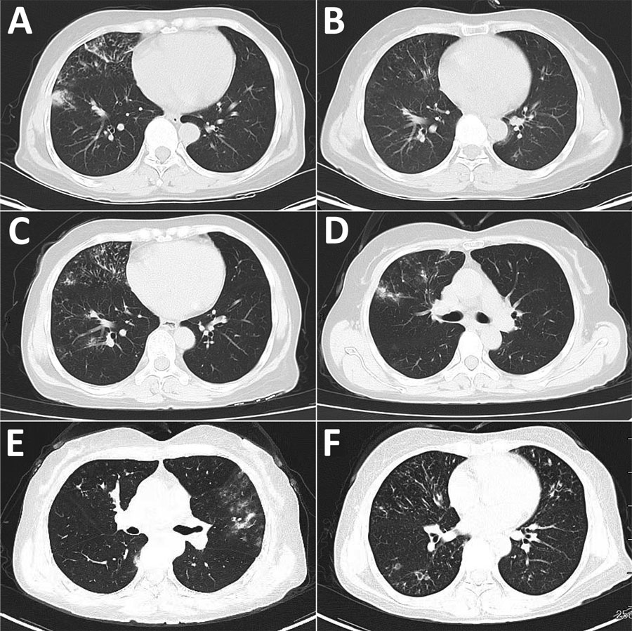 Computed tomography scans of the chest at different stages of disease in immunocompetent patient with recurrent pulmonary infection caused by Burkholderia semiarida, China. A) Infiltrative lesions in the right lung in August 2020; B) multiple infiltrative lesions in both lungs substantially resorbed in June 2021; C) multiple infiltrative lesions of both lungs, predominantly in the right lung, in February 2022; D) bronchiectasis with scattered multiple lesions in both lungs and increased exudative lesions in the right upper lung in May 2022; E) lesions in the right lung more resorbed than before and multiple emerging lesions in the left lung in August 2022; F) lesions in the left lung more absorbed than before, with multiple emerging foci in the right lung in March 2023.