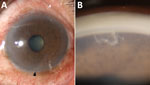 Slit-lamp examination of the left eye of a 61-year-old man in Thailand with ocular parasitosis. A) Ciliary injection and a live parasite in the inferior part of the anterior chamber (arrowhead). B) Gonioscopic view revealing a parasite in the inferior anterior chamber angle, lodged in the iris fibers. Precise magnification levels are not available.