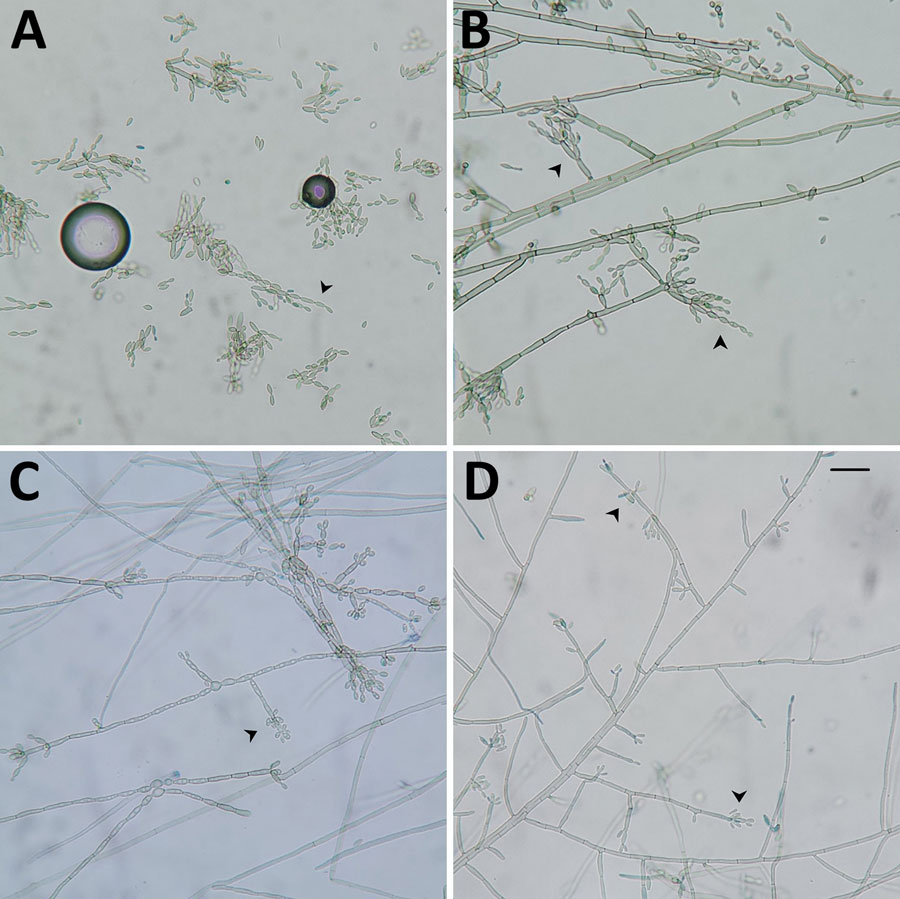 Lactophenol cotton blue mount of a culture from a brain biopsy sample from a 3-year-old patient in India with Fonsecaea monophora infection, showing dematiaceous septate hyphae with different types of conidiation (arrowheads). A) Multicelled sessile conidial chains resembling genus Cladophialophora, leading to the initial misidentification. B) Fonsecaea-type conidiation. C) Rhinocladiella-type conidiation. D) Asterisks of Fonsecaea-type conidiation.