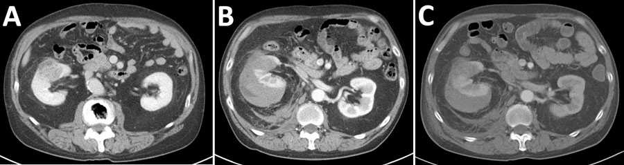 CT scans in a case of fatal renal abscess caused by Porphyromonas gingivalis and subcapsular hemorrhage, Japan. A) Contrast enhanced CT 3 days before patient admission shows a 3.5-cm large right renal mass, which was suspected to be renal carcinoma based on imaging findings. B) Contrast enhanced CT at admission. The patient was hospitalized for bleeding from the renal mass. C) Contrast enhanced CT 1 day after admission, showing a shrinking hematoma. CT, computed tomography.