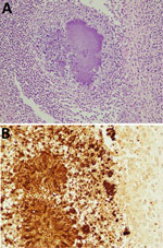 Immunology of mass in a case of fatal renal abscess caused by Porphyromonas gingivalis and subcapsular hemorrhage, Japan. A) Hematoxylin and eosin stain showing gram-negative bacteria in center. Original magnification ×100. B) Immunohistochemistry with antibody diluted 100 times. Further magnification showing gram-negative bacteria. Original magnification ×200.